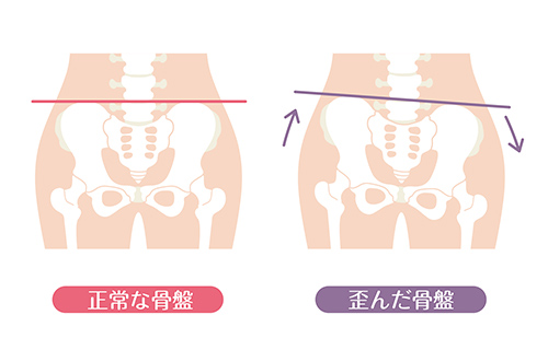 骨盤矯正とは？